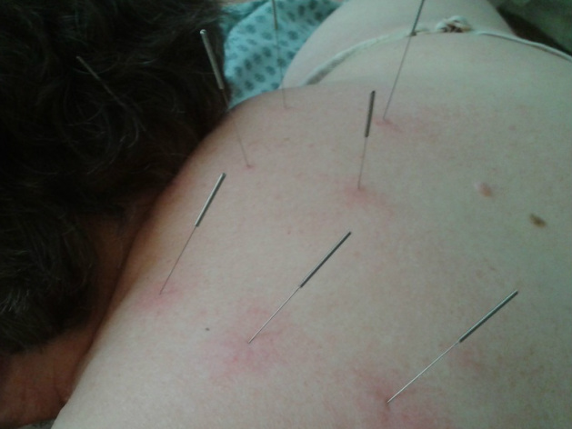 Omaha Acupuncture