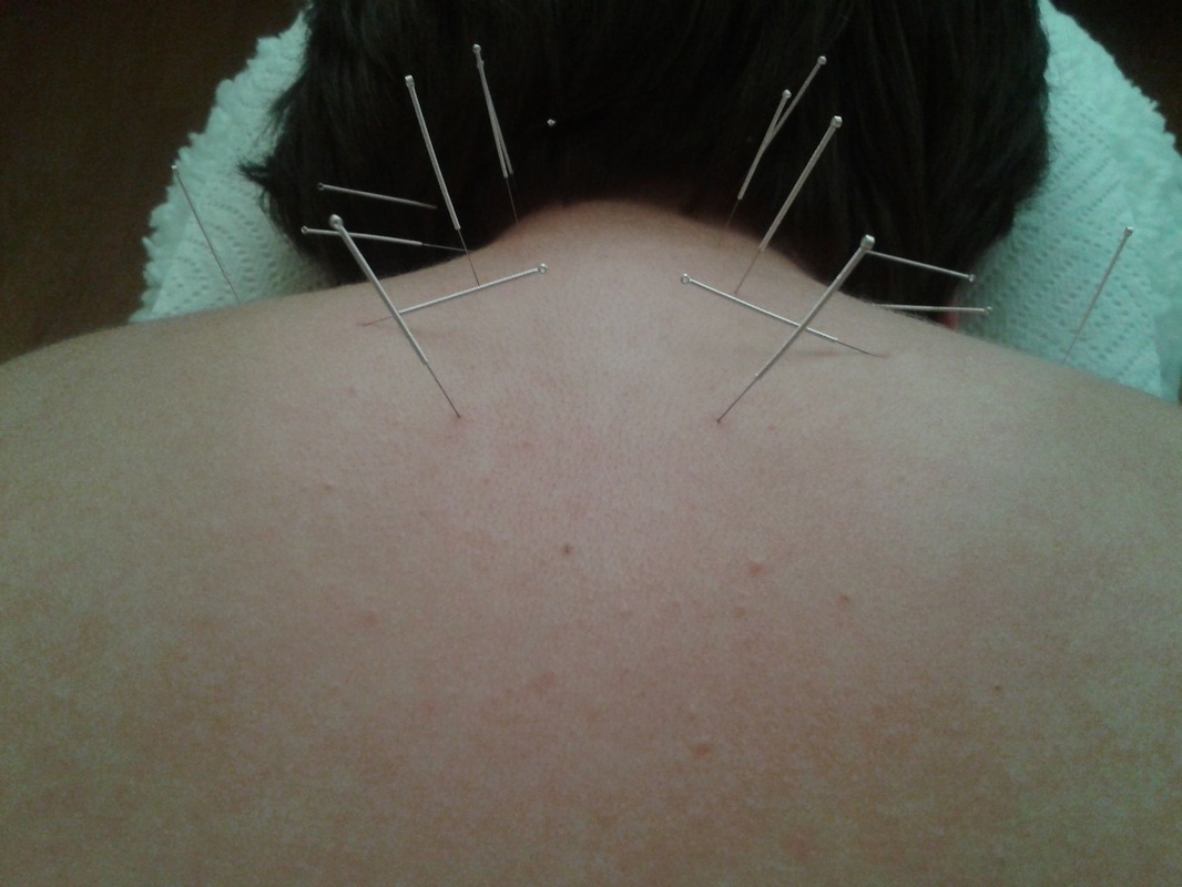 Acupuncture Omaha Fibromyalgia