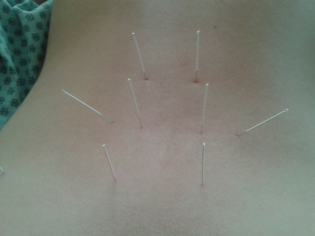 Acupuncture Omaha Fibromyalgia