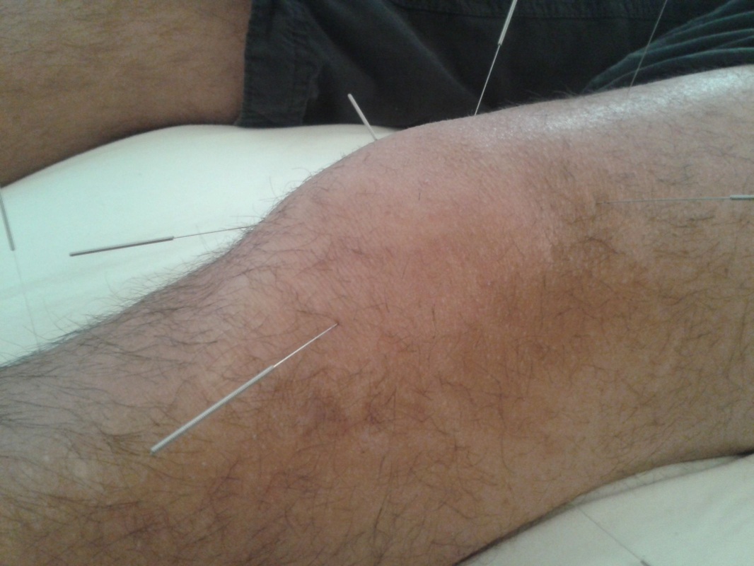 Acupuncture Omaha Knee Pain